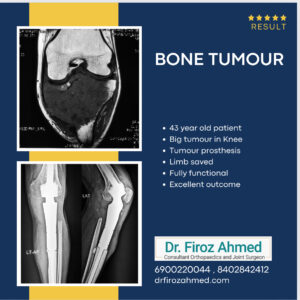 Dr Firoz Ahmed Bone Tumour