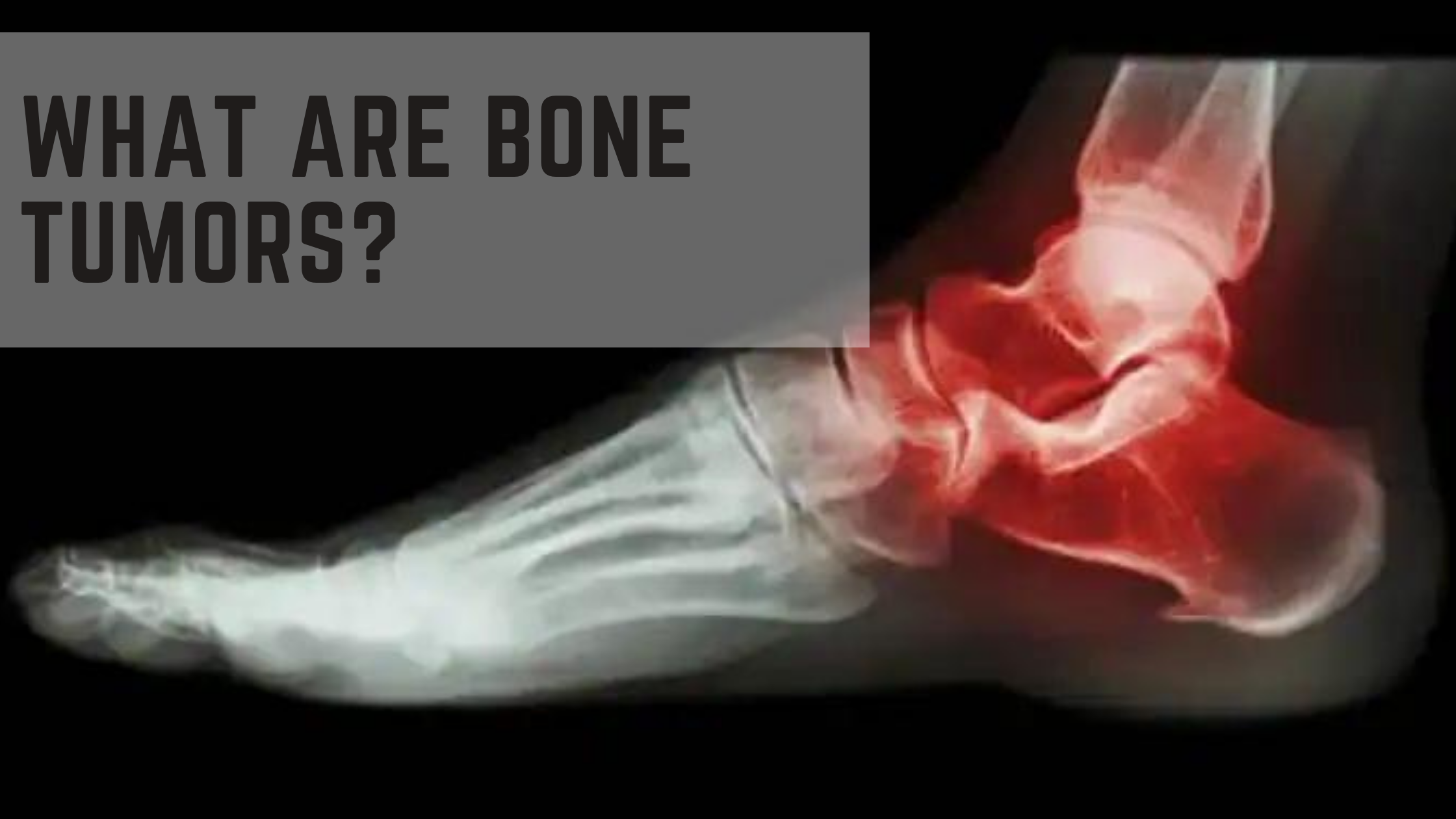 You are currently viewing What are bone tumors?