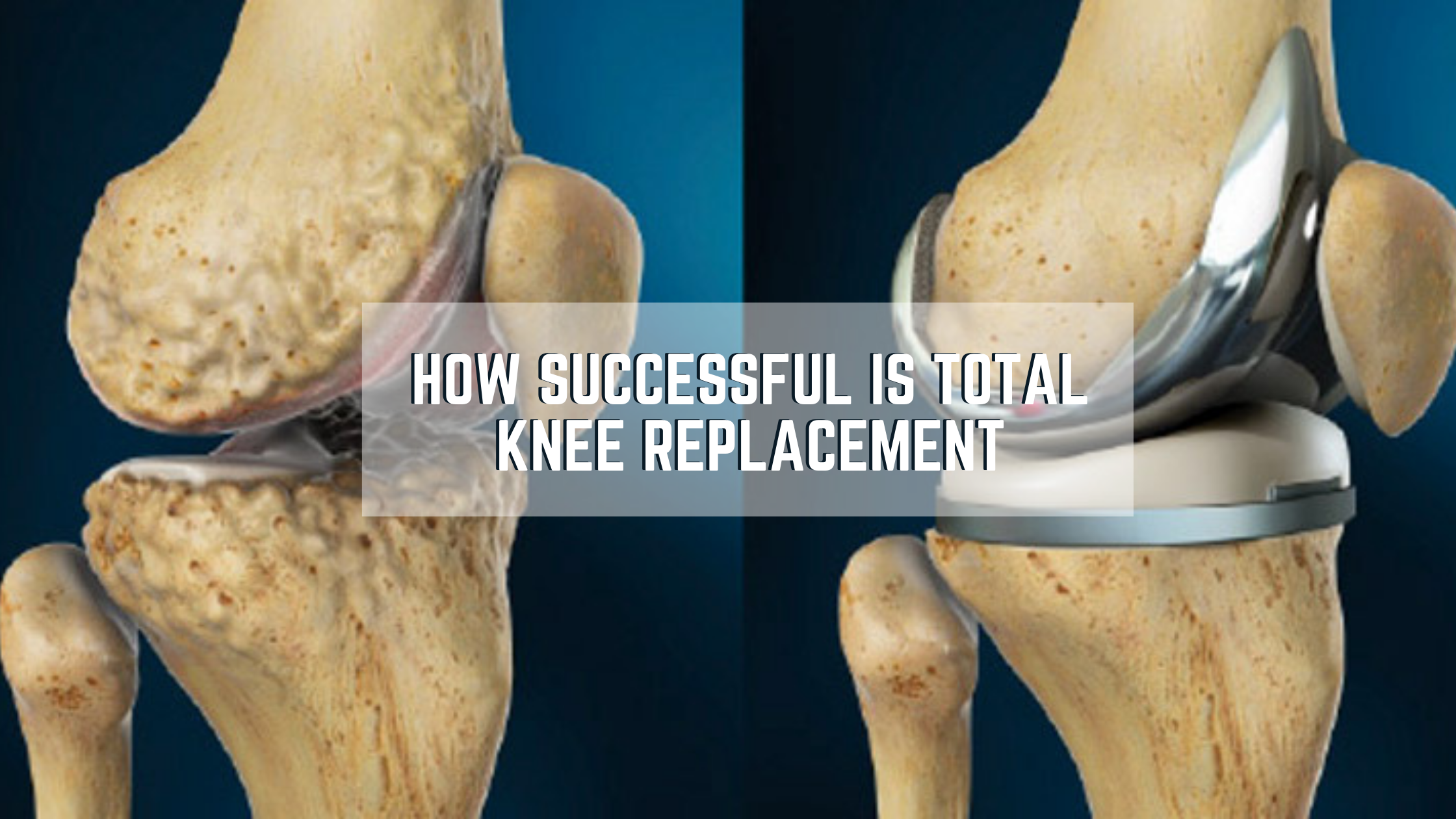 Read more about the article How successful is Total Knee Replacement
