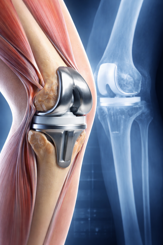 knee replacement