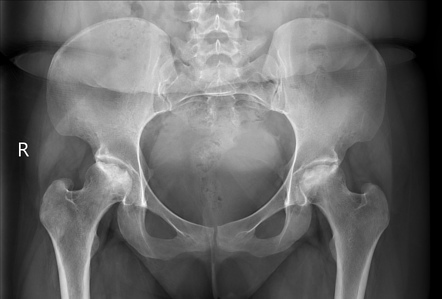 Hip_AVN_Non_Surgical_Guwhati