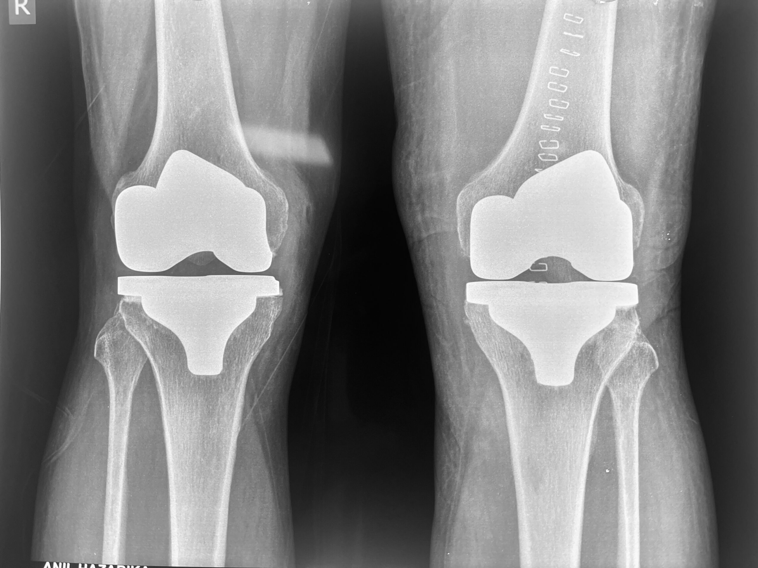 knee replacement Guwahati dr firoz ahmed