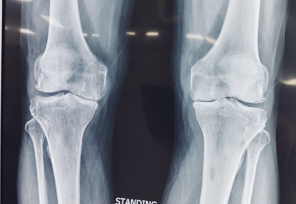 knee replacement Guwahati dr firoz ahmed