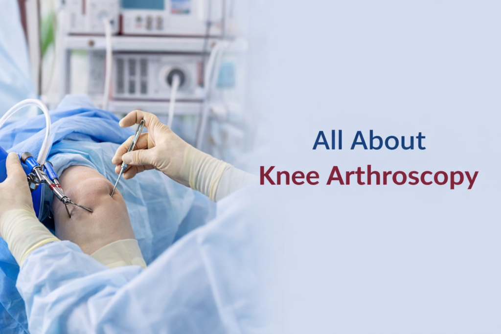 knee arthroscopy guwahati