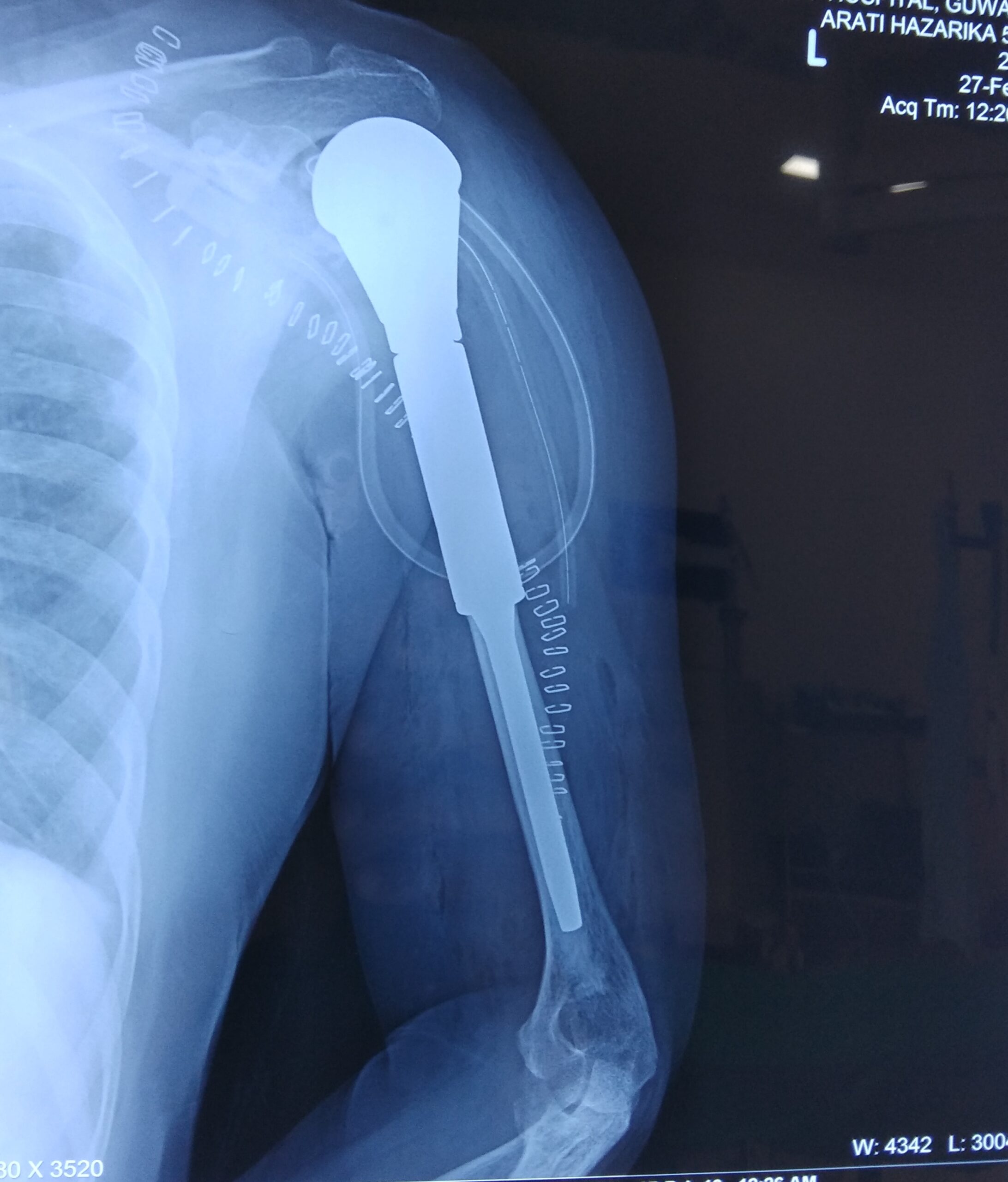 chondrosarcoma bone tumour treatment by dr firoz ahmed guwahati