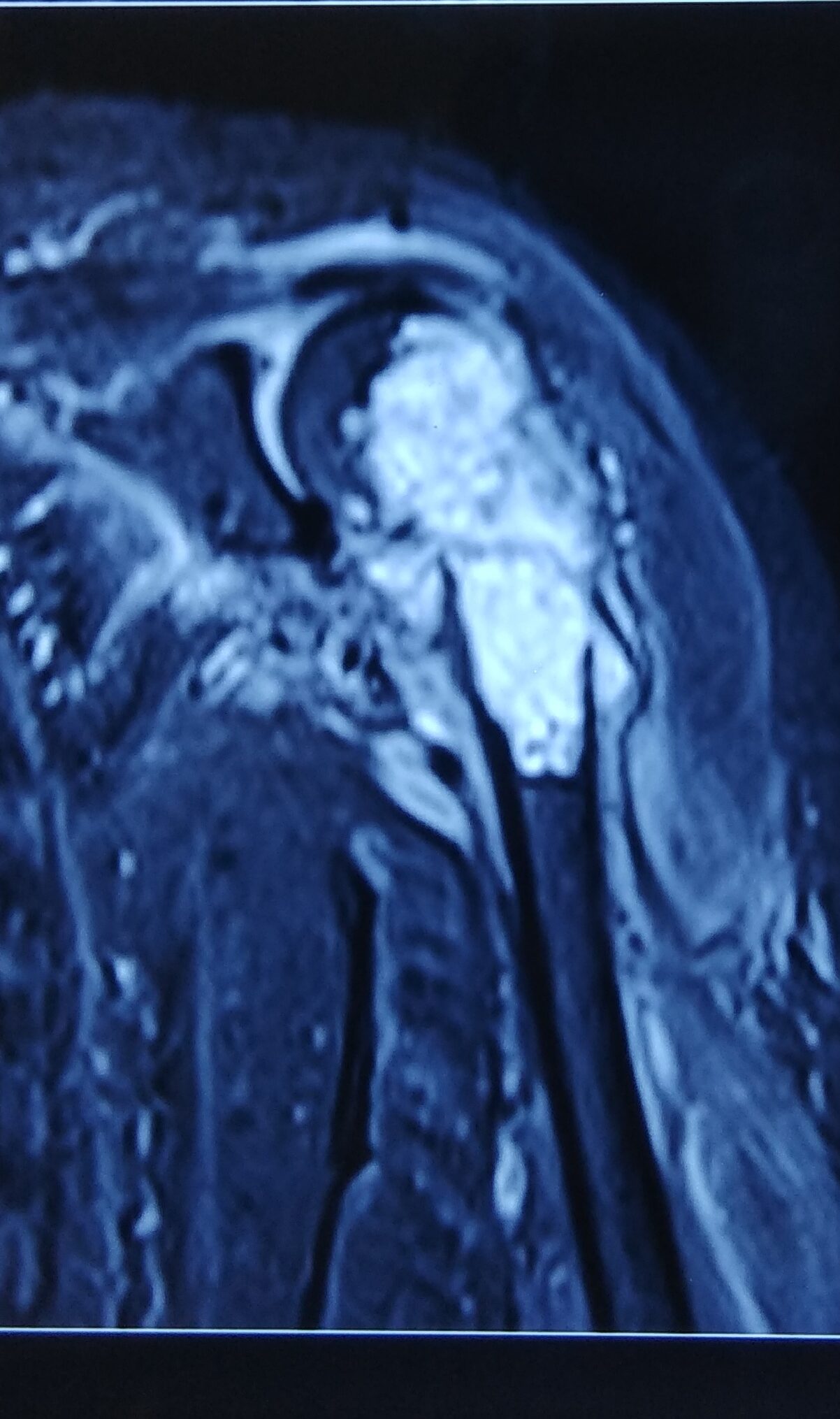chondrosarcoma bone tumour treatment by dr firoz ahmed guwahati