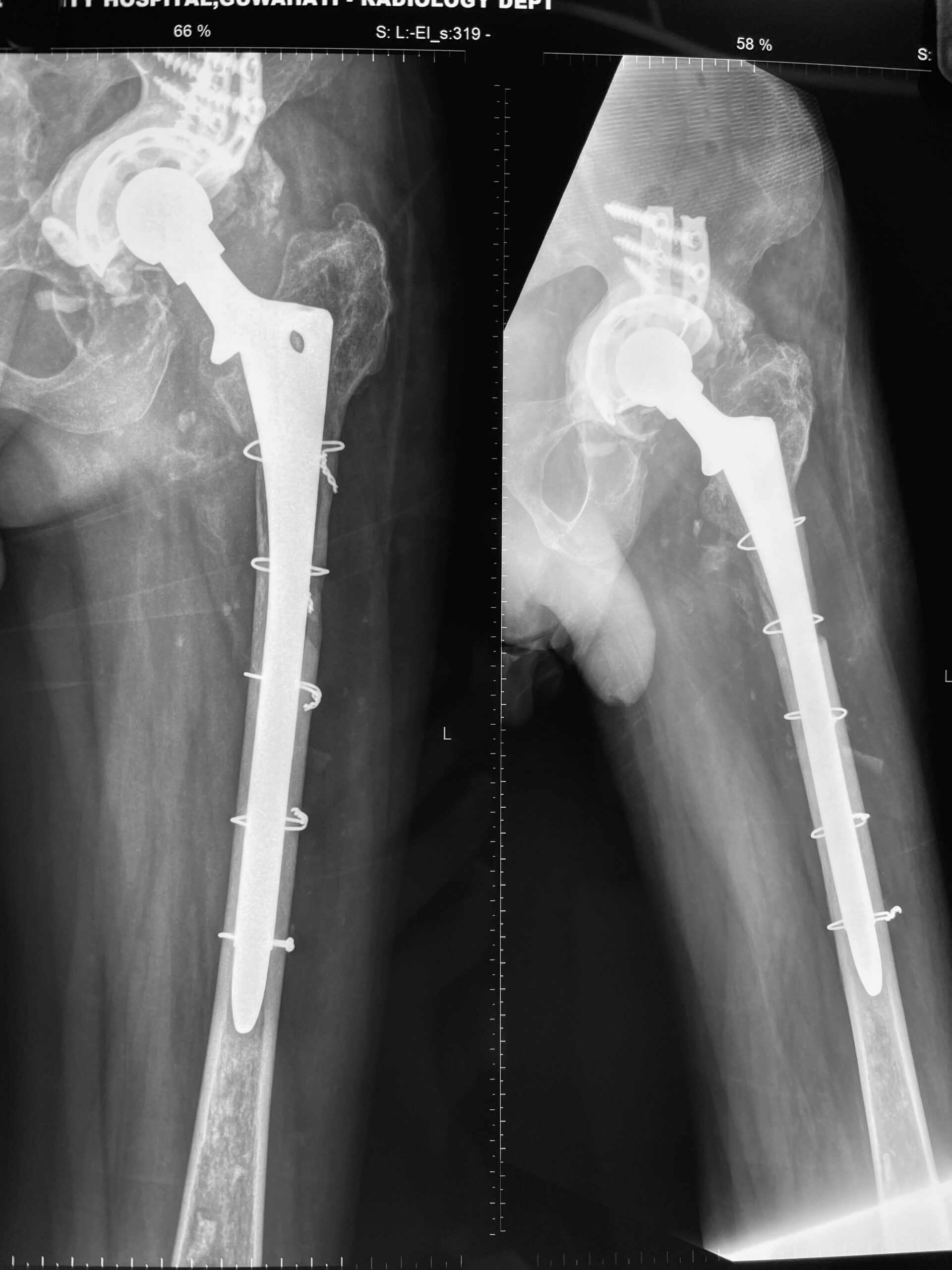 revision total hip replacement dr firoz ahmed guwahati