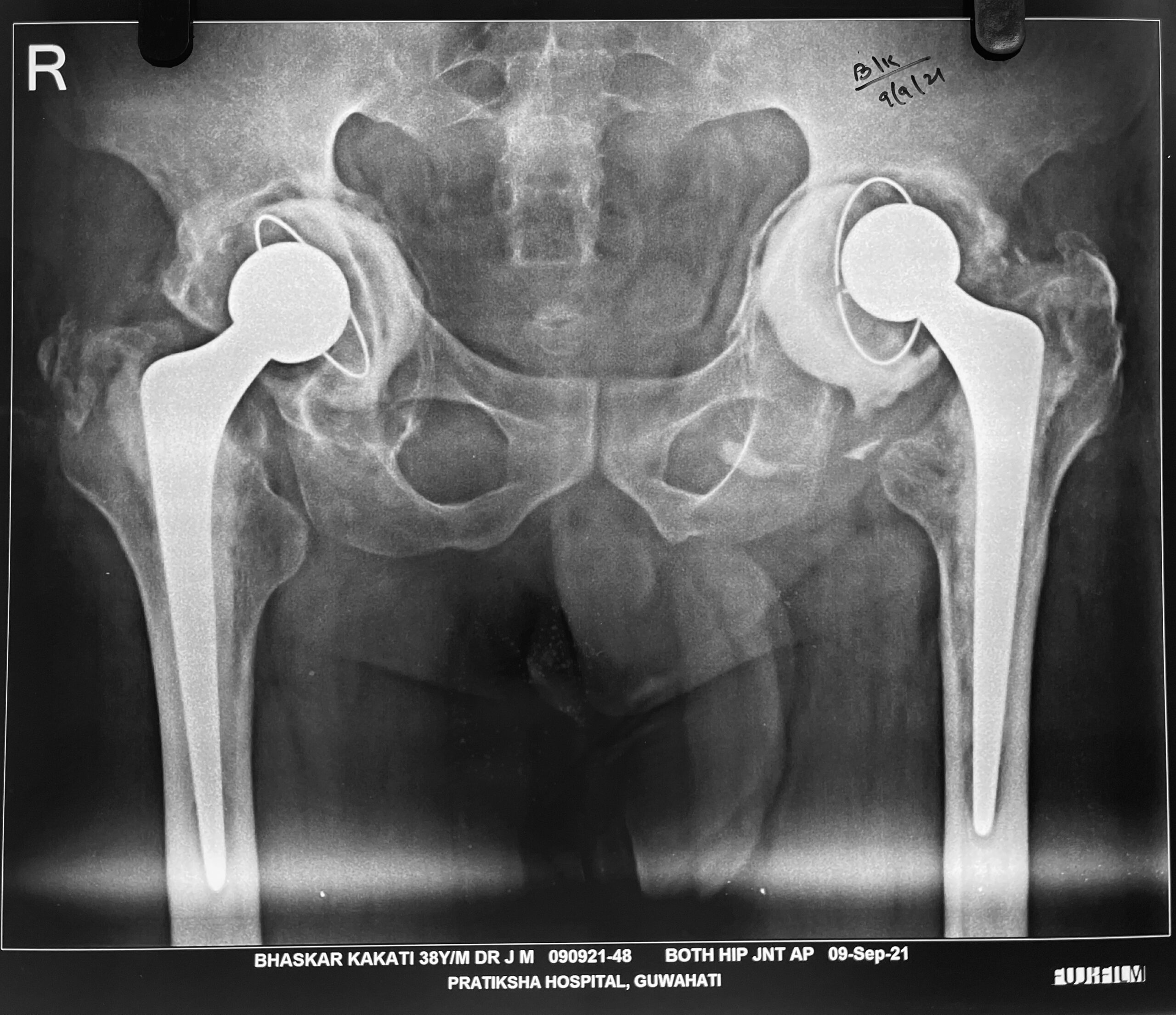 hip replacement dr firoz ahmed guwahati