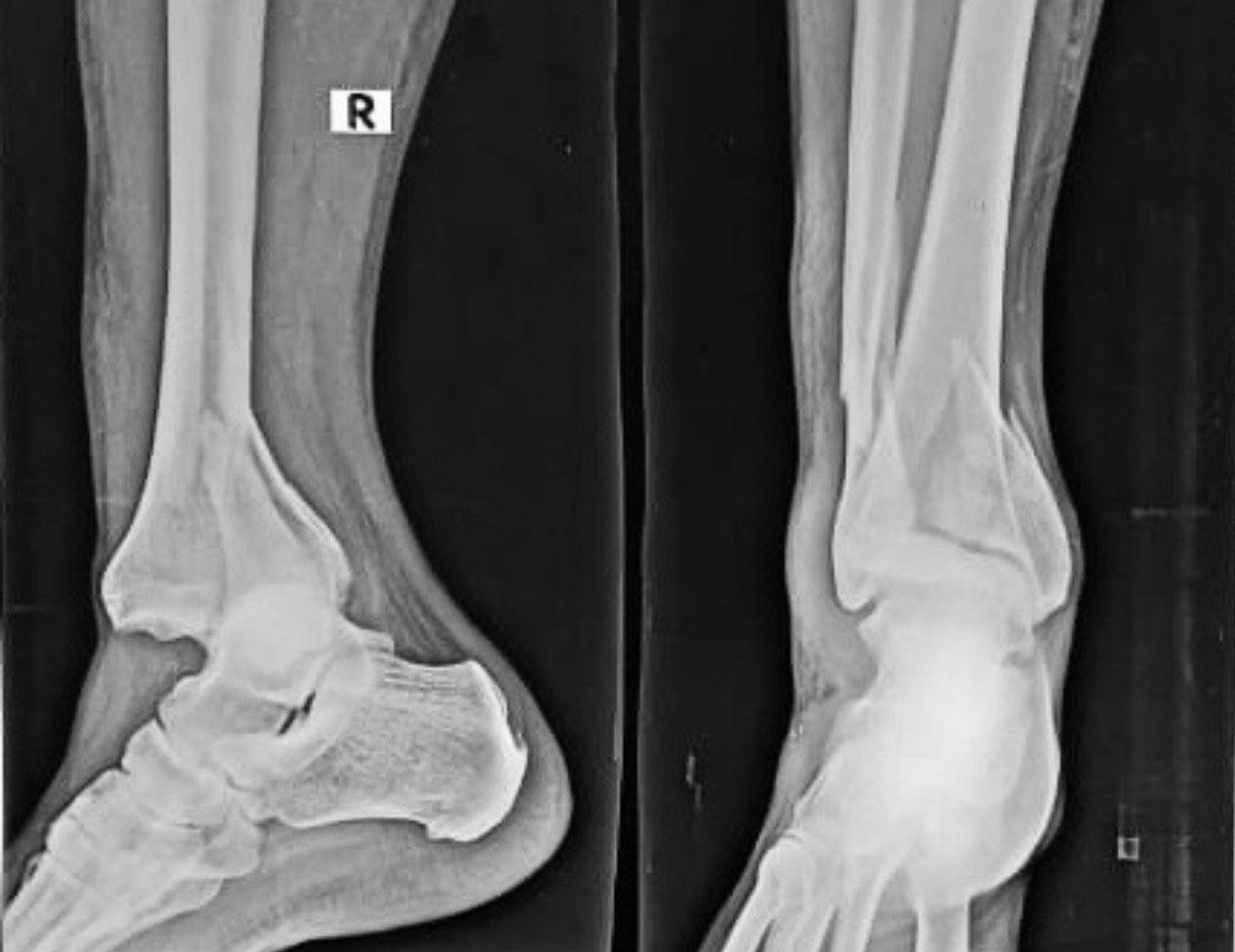 ankle fracture treatment operation guwahati firoz ahmed