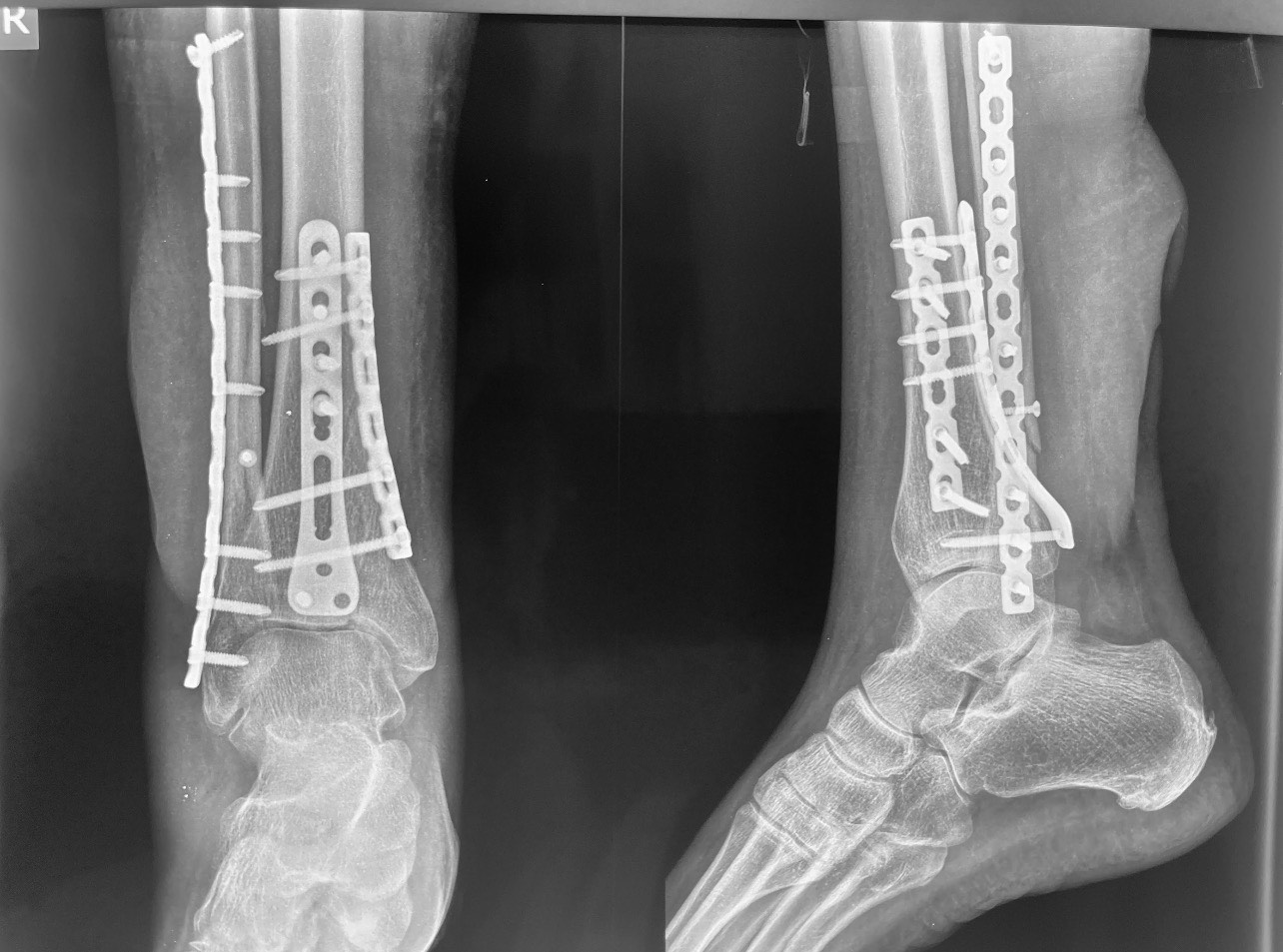 ankle fracture treatment operation guwahati firoz ahmed