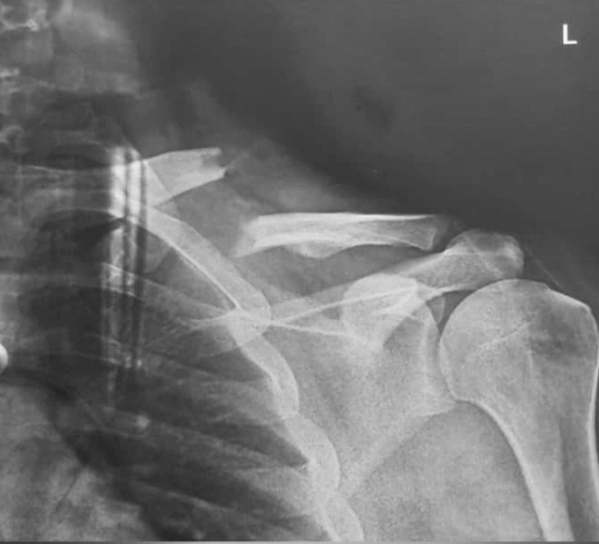clavicle fracture treatment operation guwahati firoz ahmed