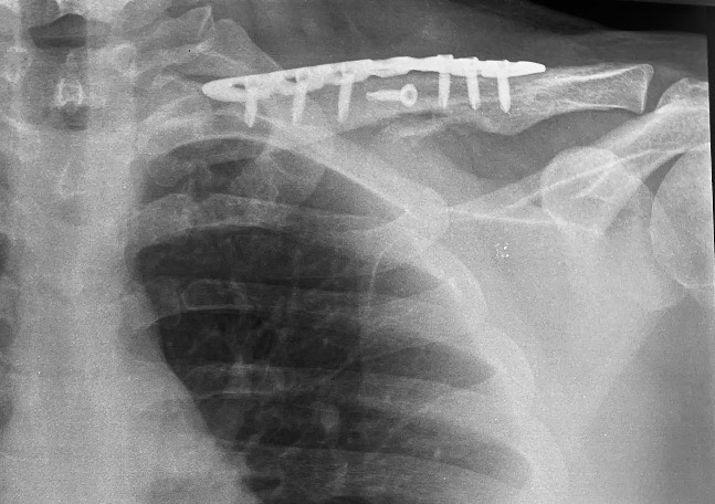 clavicle fracture treatment operation guwahati firoz ahmed