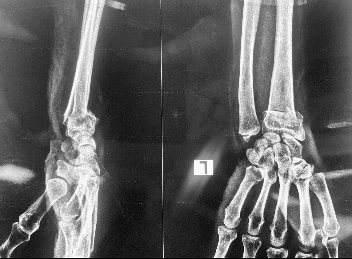 wrist fracture treatment operation guwahati firoz ahmed
