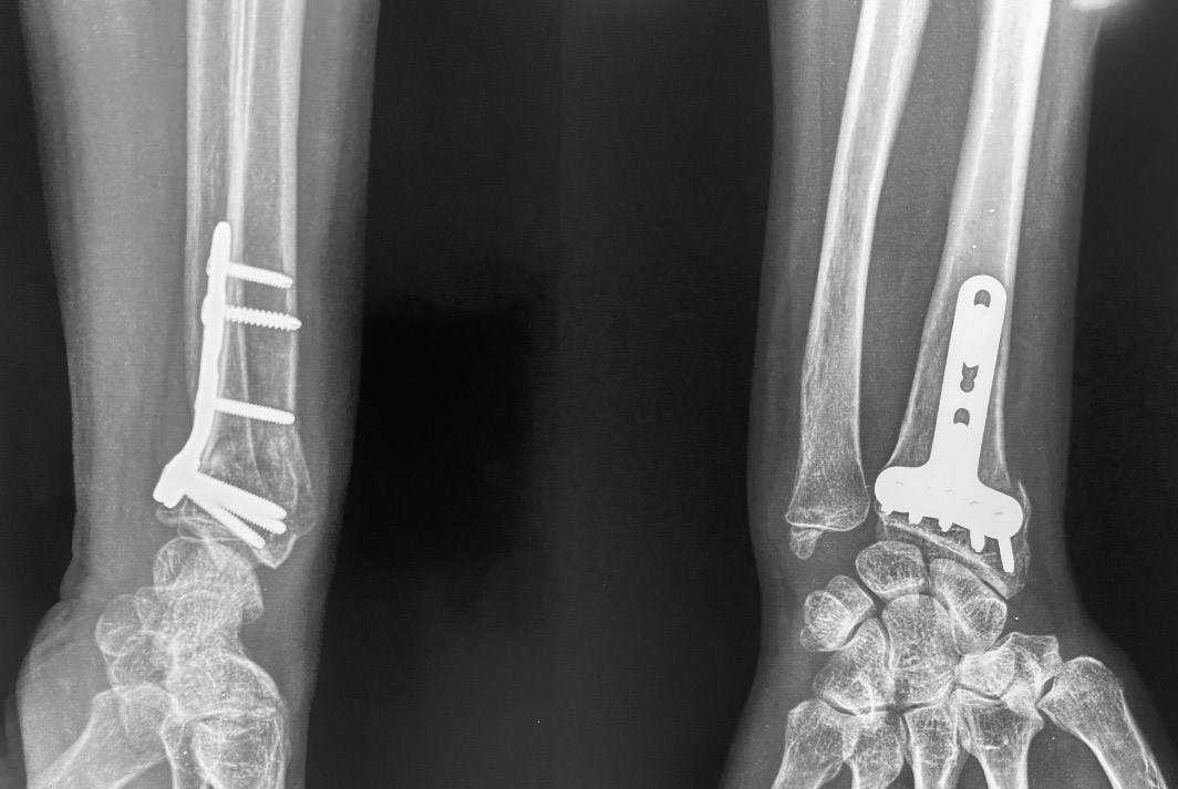 wrist fracture treatment operation guwahati firoz ahmed
