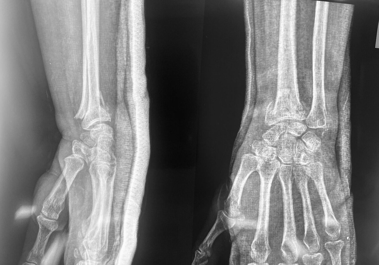 wrist fracture treatment operation guwahati firoz ahmed