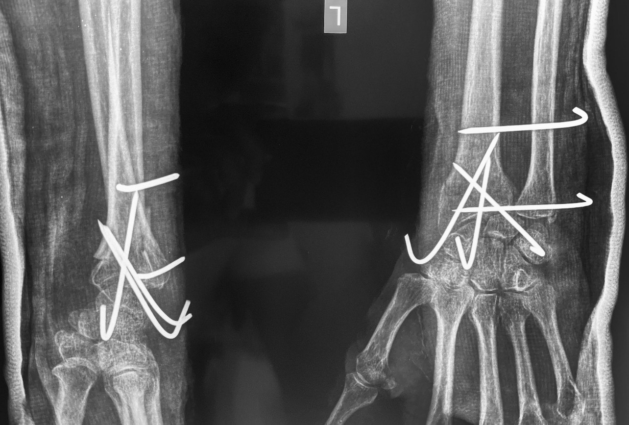 wrist fracture treatment operation guwahati firoz ahmed