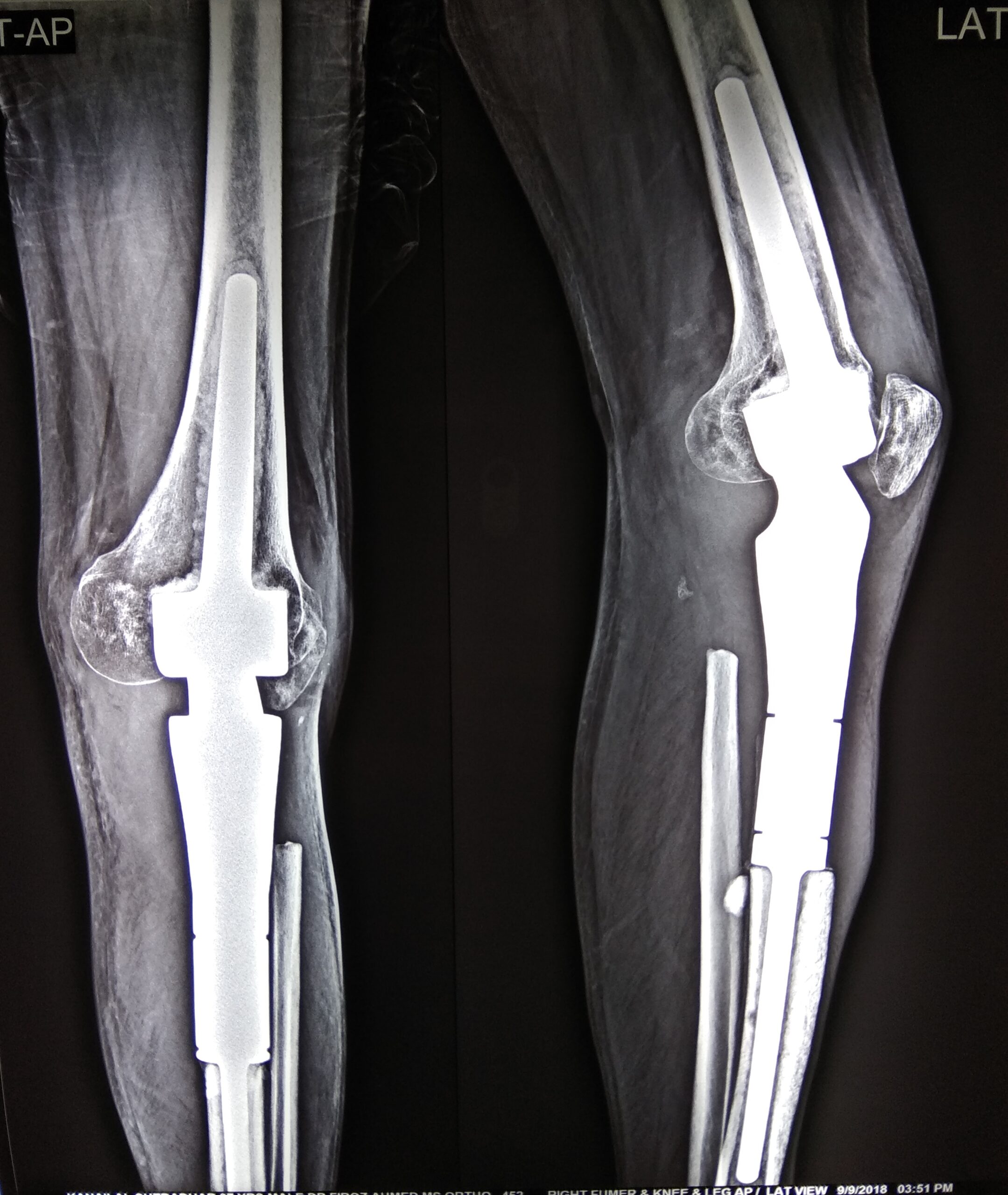 bone tumour xray in guwahati treated by dr firoz ahmed