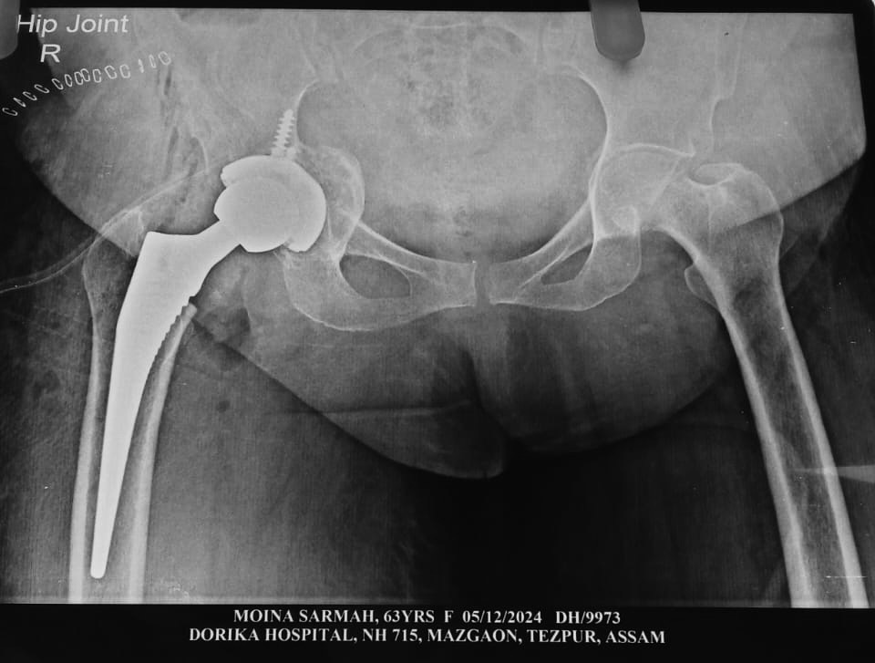 hip-replacement-dr-firoz-ahmed-guwahati