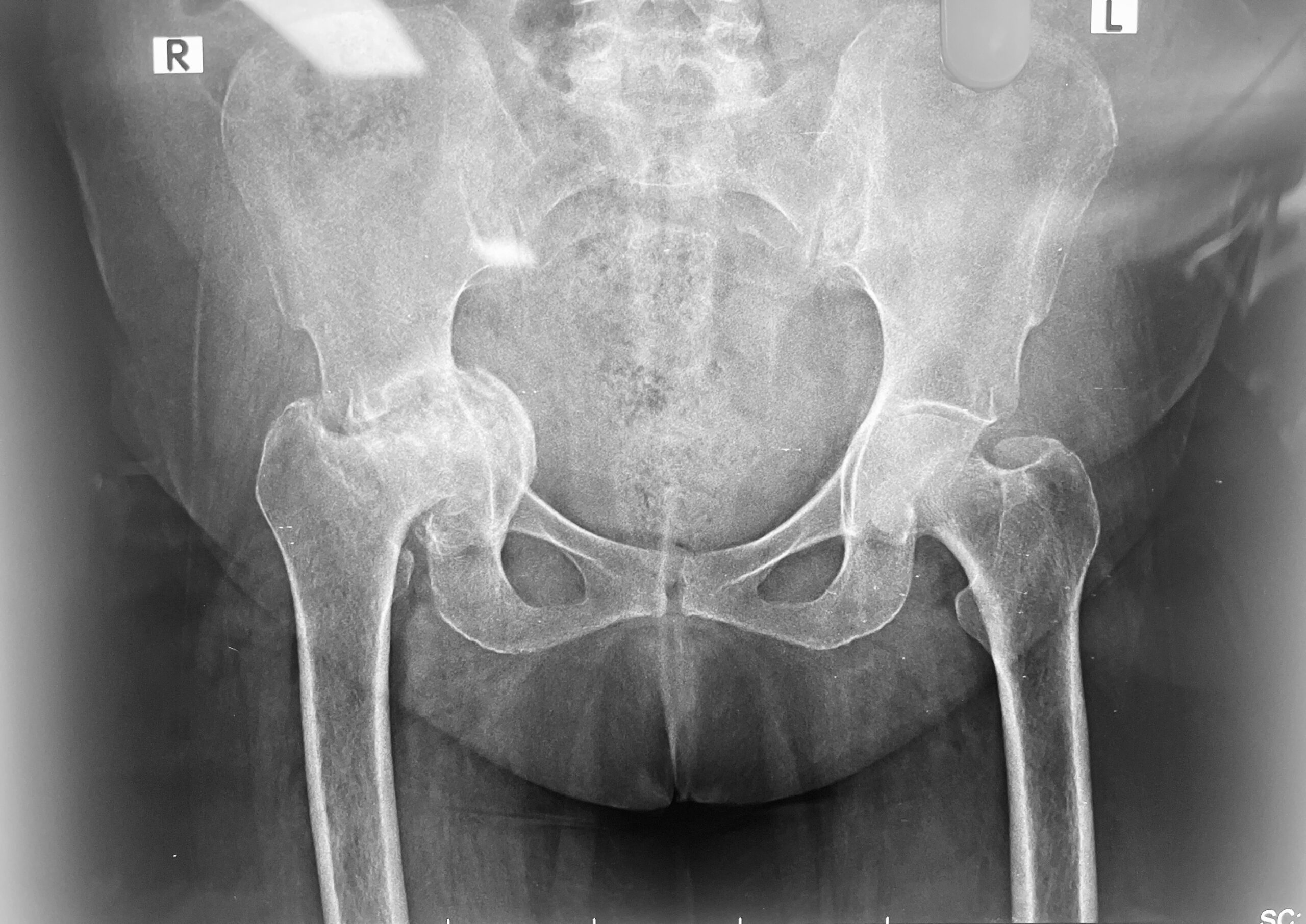 hip replacement dr firoz ahmed guwahati