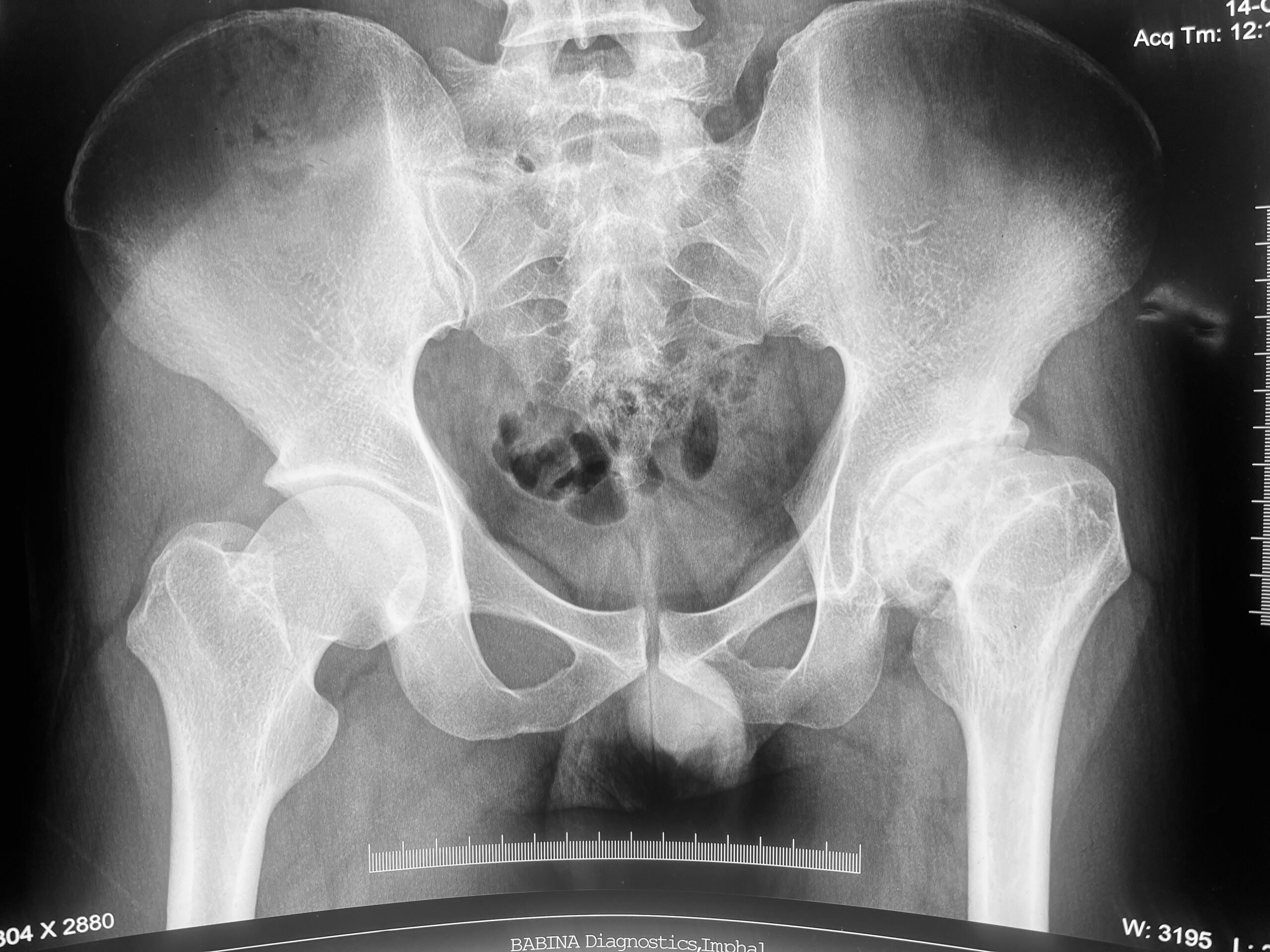 hip replacement dr firoz ahmed guwahati