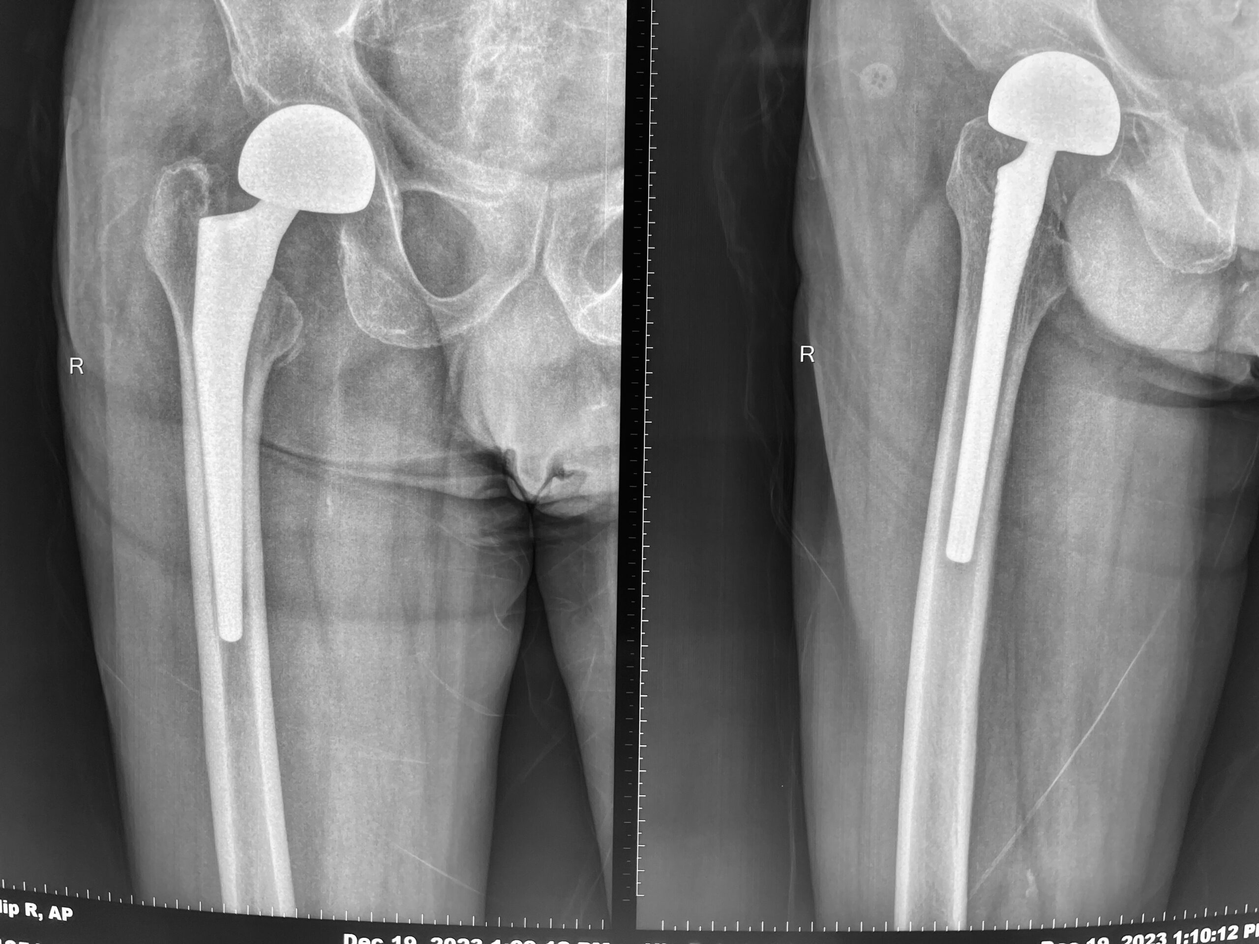 hip-replacement-dr-firoz-ahmed-guwahati