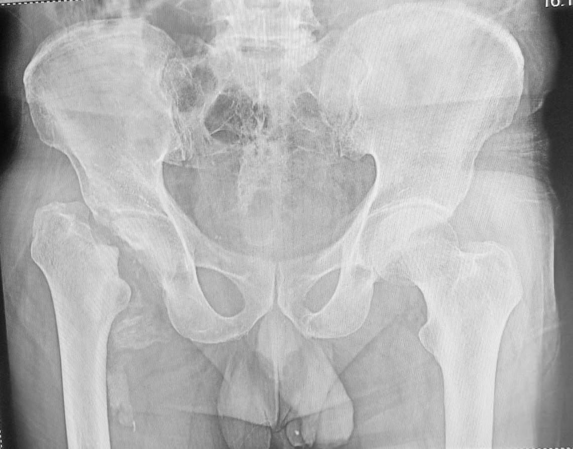hip replacement dr firoz ahmed guwahati