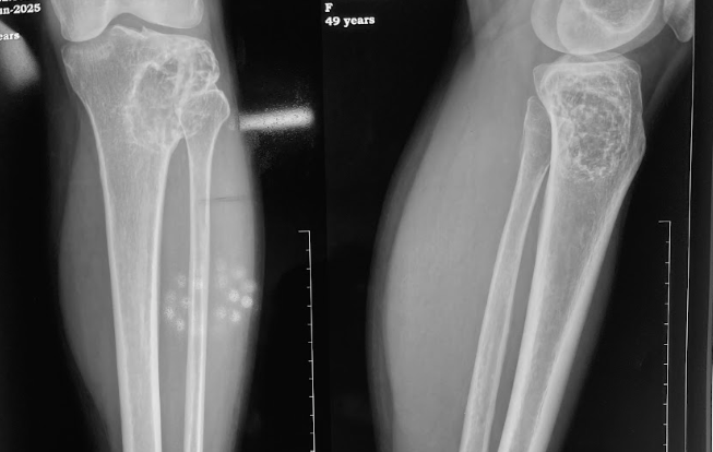 bone-tumour-xray-in-guwahati-treated-by-dr-firoz-ahmed