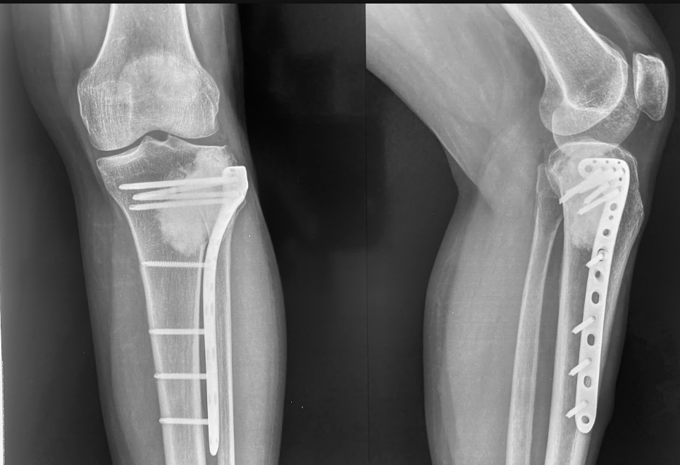 bone-tumour-xray-in-guwahati-treated-by-dr-firoz-ahmed