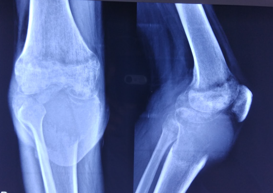 bone tumour xray in guwahati treated by dr firoz ahmed